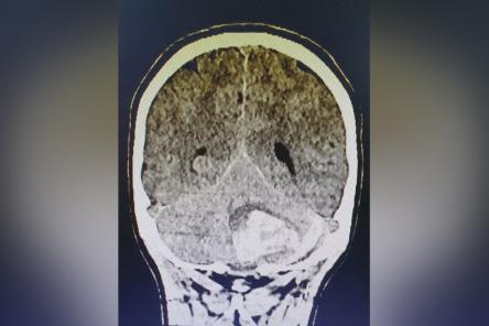 Нижегородские хирурги спасли 15-летнюю пациентку с кровоизлиянием в мозг