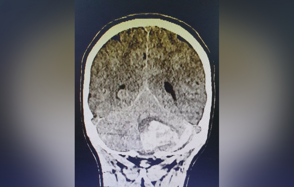 Нижегородские хирурги спасли 15-летнюю пациентку с кровоизлиянием в мозг - фото 1