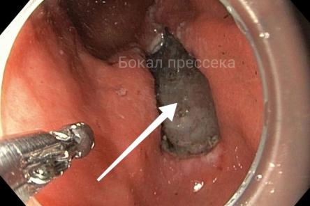 Мужчину с бессимптомным раком желудка спасли нижегородские врачи